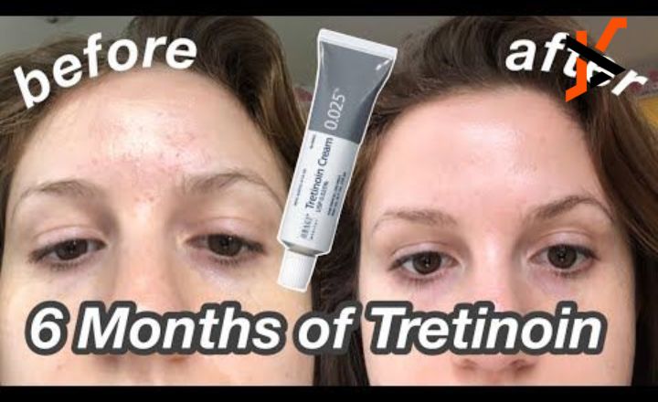 Tretinoin Before and After