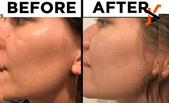 Tretinoin Before and After