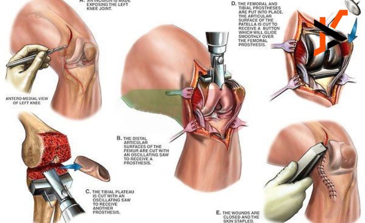 top 5 mistakes after knee replacement