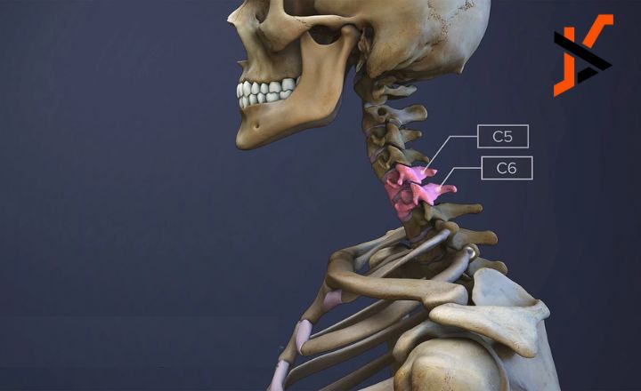 Neck surgery C5-C6-C7 Recovery Time