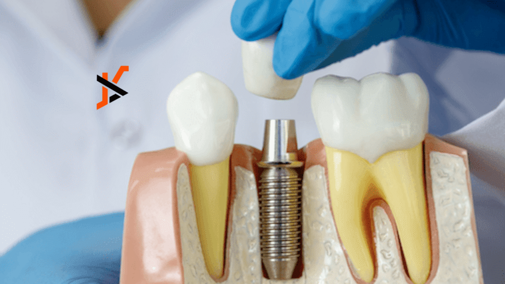 The Wobbling of Dental Implants. What to do?