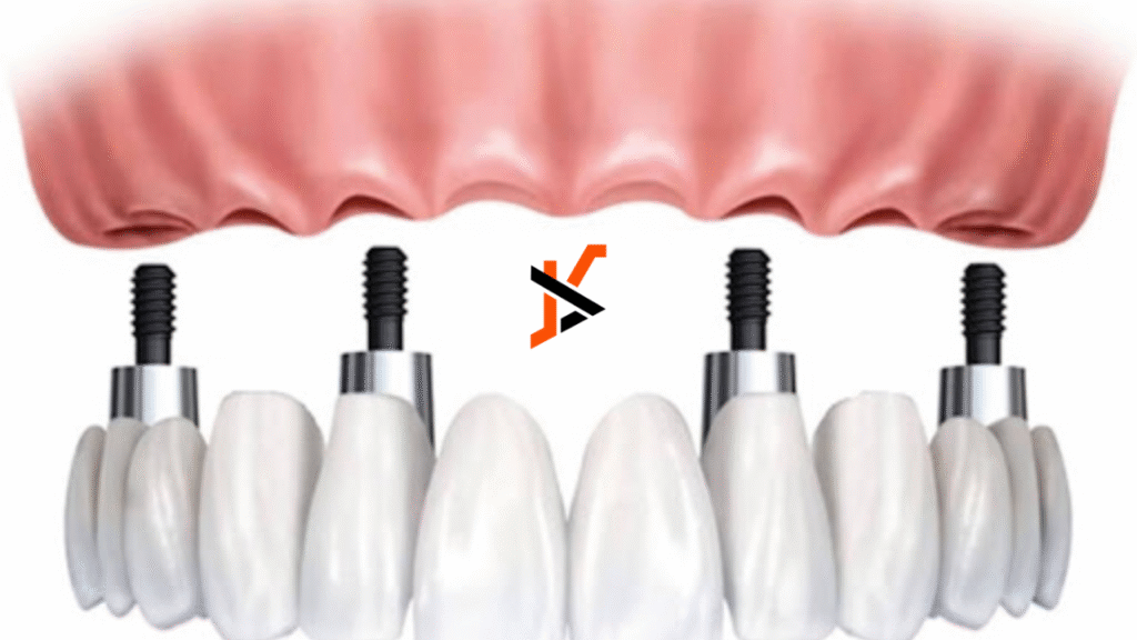 All On 4 Zirconia Bridge Cost