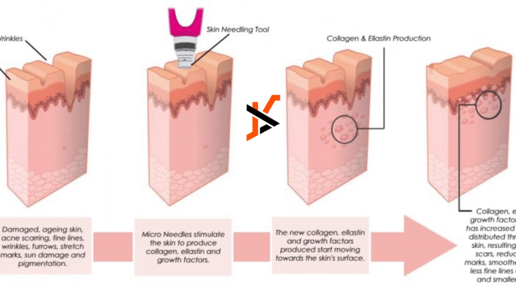 The Benefits and Techniques of Skin Needling