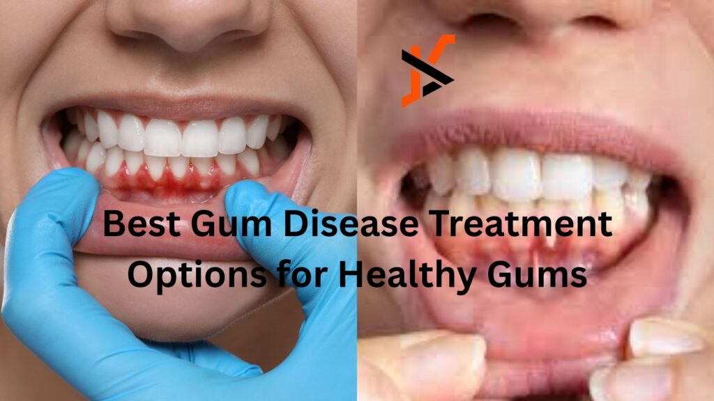 Best Gum Disease Treatment Options for Healthy Gums