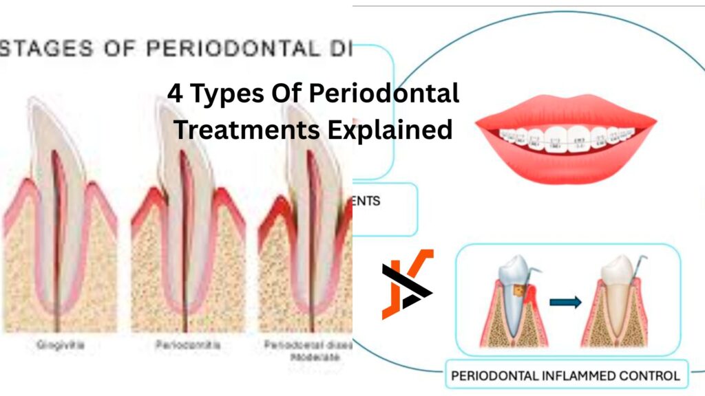 4 Types Of Periodontal Treatments Explained